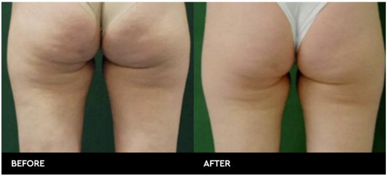 Cellulite removal treatment Aesthetics labs